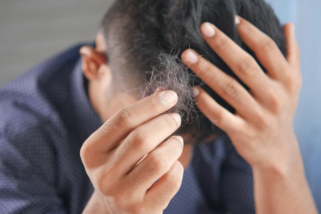 Addressing Hair Loss as a Health Indicator for Men