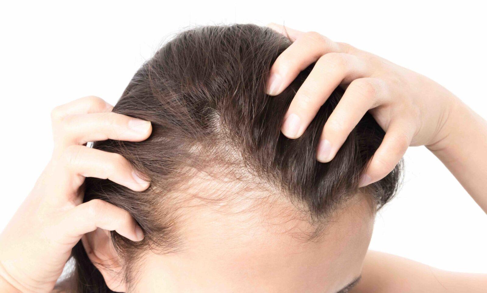 Nutritional ​Strategies to ⁢Support Hair Growth