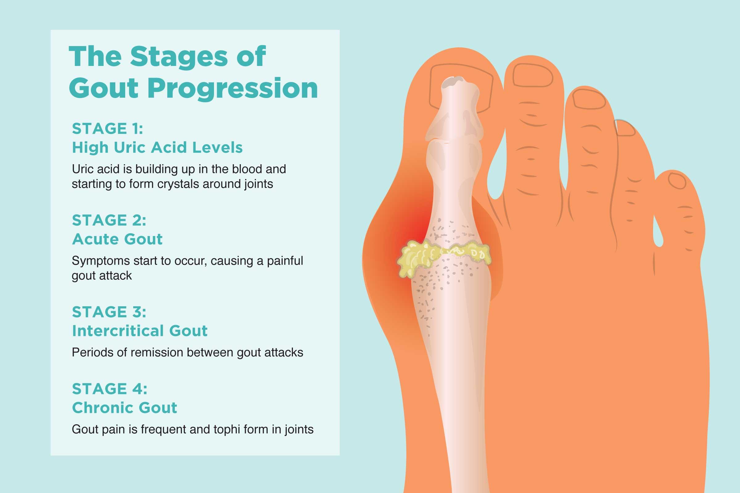 Recognizing the Subtle Symptoms of Worsening Arthritis